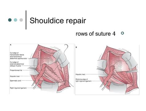 Types of Repair - Sports Hernia Specialist