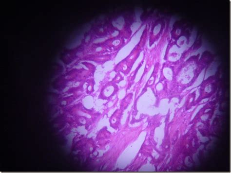 Histology Slides Database: Adenocarcinoma histopathology