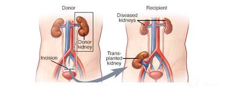 Kidney transplant