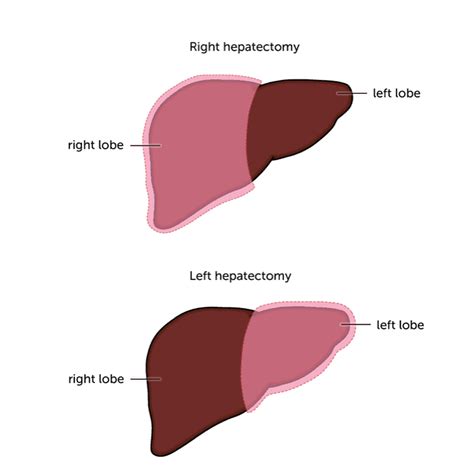 Types of surgery - Liver Cancer UK