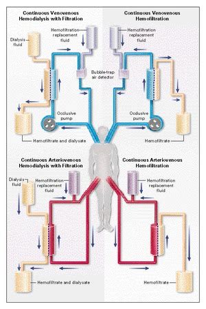 Continuous Hemofiltration in the Treatment of Acute Renal Failure | NEJM