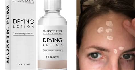 16 Of The Best Acne Spot Treatments You Can Get On Amazon In 2018