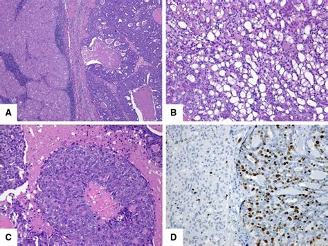 High-grade transformation of acinic cell carcinoma. a Low-power view of ...