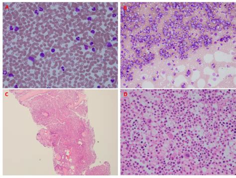 Bone marrow biopsy from April 2020 and diagnosis of CML. A. The ...