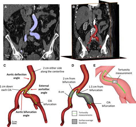 Morphology And Hemodynamics In Isolated Common Iliac Artery Aneurysms ...