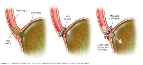 Pictures Of Acid Reflux Damage To Throat