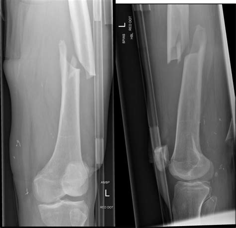 Atypical bilateral femoral fractures: a rare adverse effect of long-term bisphosphonate use ...