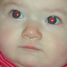 Baby Photos Can Reflect Serious Eye Disorders | HuffPost