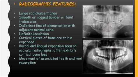 Peripheral and central giant cell granuloma