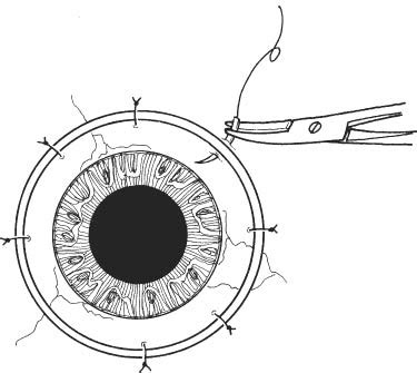 Penetrating Keratoplasty | Ento Key