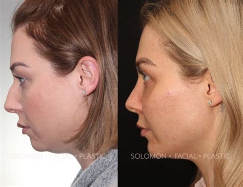 Chin Implants | Chin Augmentation in Toronto | Dr. Solomon