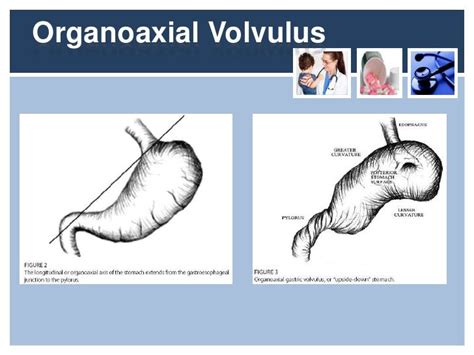 Gastric volvulus