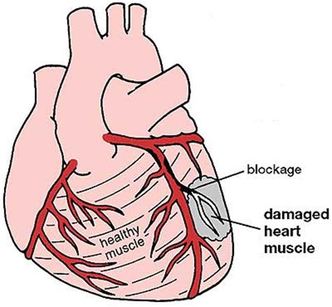 Understand Heart Attack (Myocardial Infarction), Causes, Mechanism, Symptoms | MedicoTips.Com