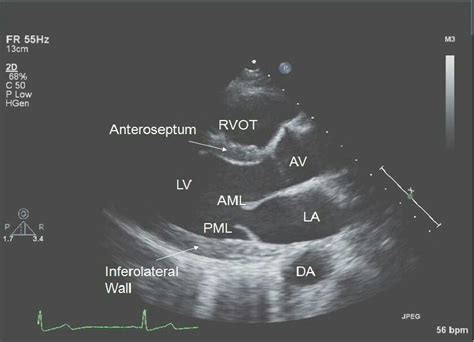 Pin by Amy Bourg on echo | Diagnostic medical sonography, Cardiac ...