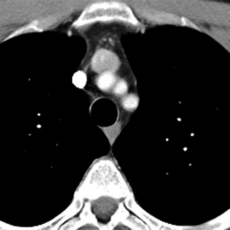 Normal Mediastinum (Axial CT) [2 of 5]