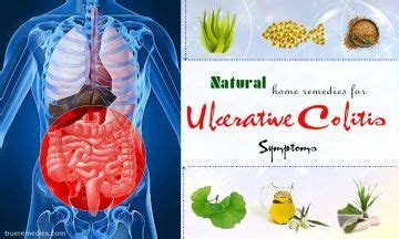 25 Home Remedies For Ulcerative Colitis Symptoms