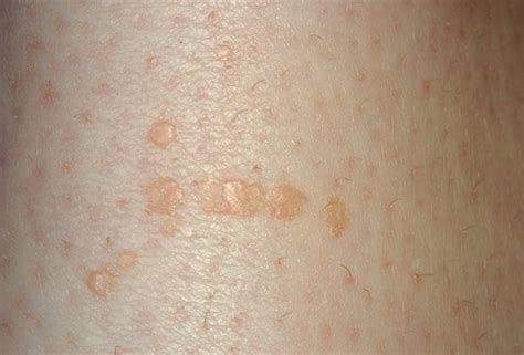 hpv flat warts - pictures, photos