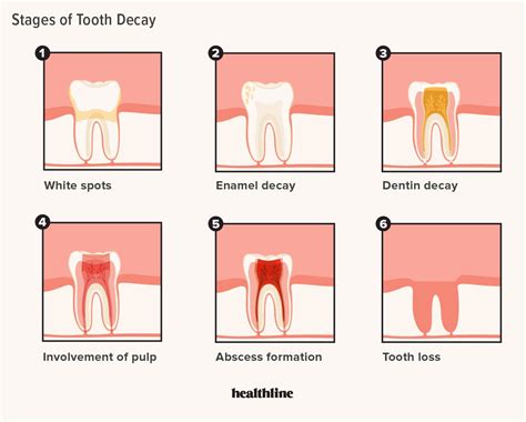 Tooth Decay1 – Exploring Biology