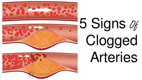 Arteries In Neck Clogged / Carotid Artery Surgery in Riverview, FL To Help Prevent ... / The ...