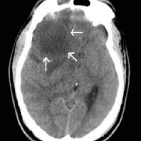 Axial CT (soft-tissue window) demonstrating hypodense right frontal... | Download Scientific Diagram