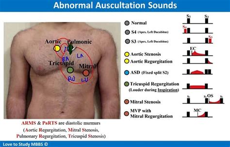 Abnormal Auscultation Sounds in 2021 | Aortic stenosis, Med school student life, Heart murmur