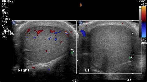 Testicular Torsion Pain Spermatic cord torsion; testicular torsion