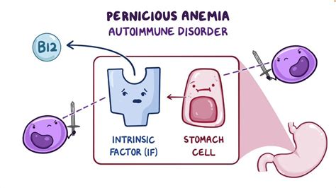 Pernicious Anemia: What It Is, Causes, Signs, Symptoms, And, 44% OFF