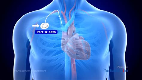 Port Catheter Placement Video | Medical Video Library