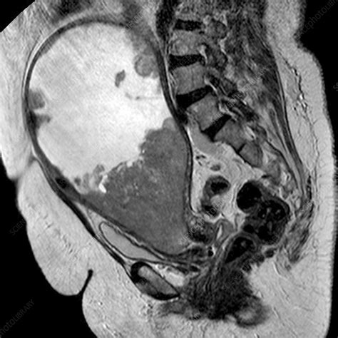 Cancer of the uterus, MRI scan - Stock Image - C011/9588 - Science ...