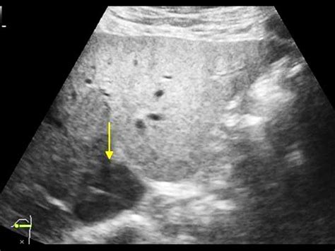 Hypoechoic Liver Lobe | Case Studies | POCUS.org