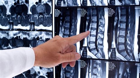 ¿Por qué se realiza la resonancia magnética lumbar? - Blog de Uniteco