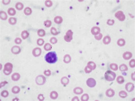 Peripheral Blood Smear Examination