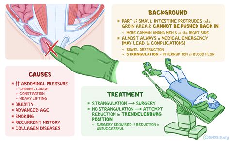 Incarcerated Inguinal Hernia: What Is It | Osmosis