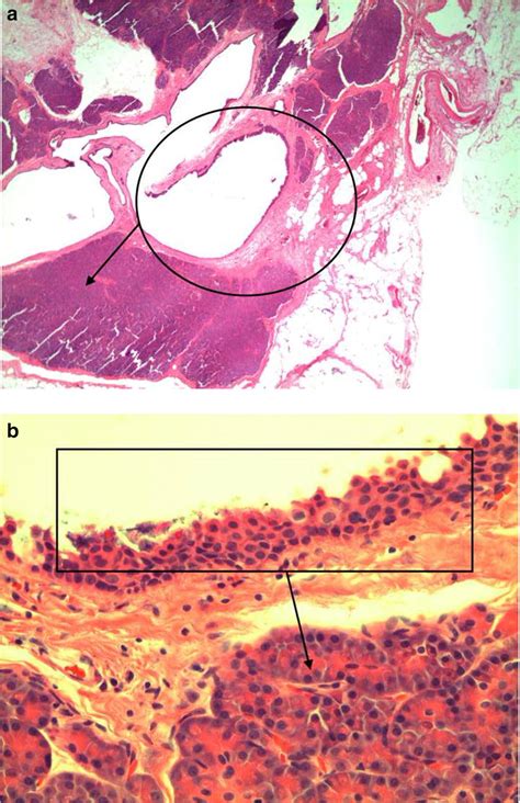 Cyst histology a 100X. Multicystic spaces noted (an example circled ...