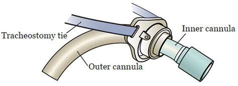 Tracheostomy - Procedure, Care, Tracheostomy Complications