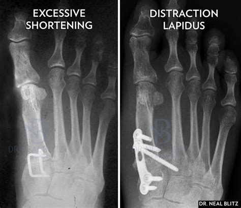 Addressing Common Complications Of The Lapidus Bunionectomy