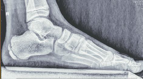 X-ray of sclerosis in the calcaneal apophysis with fragmentation. | Download Scientific Diagram