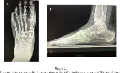 Figure 1 from Treatment of Pes Planovalgus Deformity following Failed Arthrodesis in a Patient ...