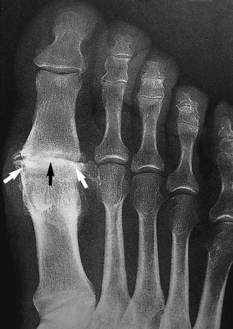 Arthritis of the Foot and Ankle - OrthoInfo - AAOS