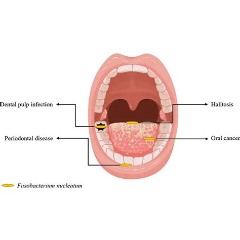 Fusobacterium Infection | Test Price in Delhi | Ganesh Diagnostic