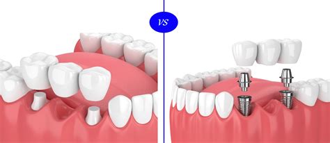 Dental Implants versus Crown and Bridge | Healthengine Blog