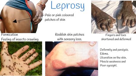 Leprosy - Nurses Revision