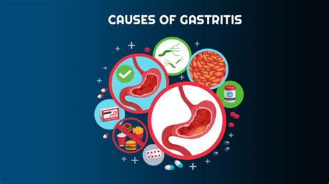 Gastritis-Causes, Treatment And Diagnosis – NutritionFact.in