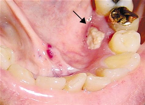 Bisphosphonate-associated osteonecrosis: a long-term complication of bisphosphonate treatment ...