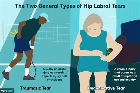 Manual Tests For Hip Labral Tear