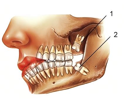 Wisdom Teeth Removal in Sydney - Sydney Dental Surgeons