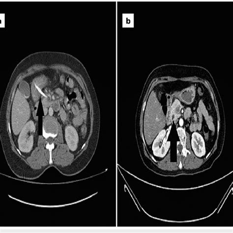 Endoscopic view of foreign objects at prepyloric region of the stomach ...