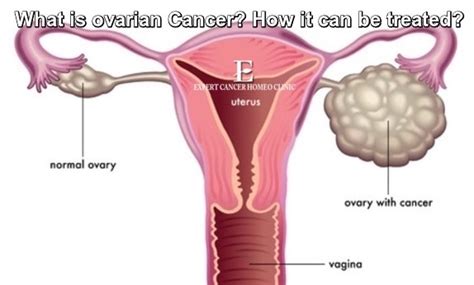 Ovarian Cancer Homeopathy Treatment In Mumbai, Delhi & Lucknow - Expert ...