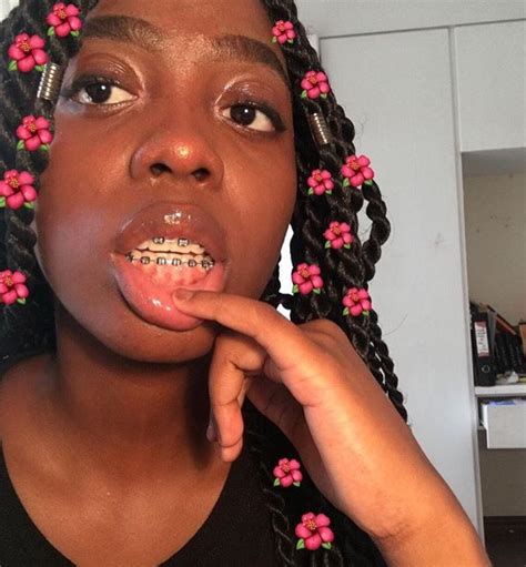 Rose Gold Black People With Braces | BRACES POST