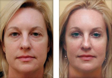 Remove Wrinkles With 5 Easy And Simple Steps - Fitneass